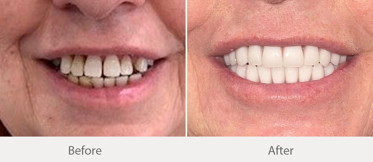 All-on-4-before-after img3