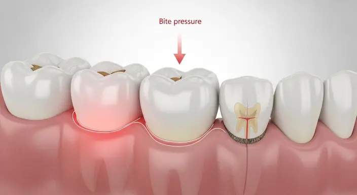 Dental crown sitting too high and causing bite misalignment when chewing