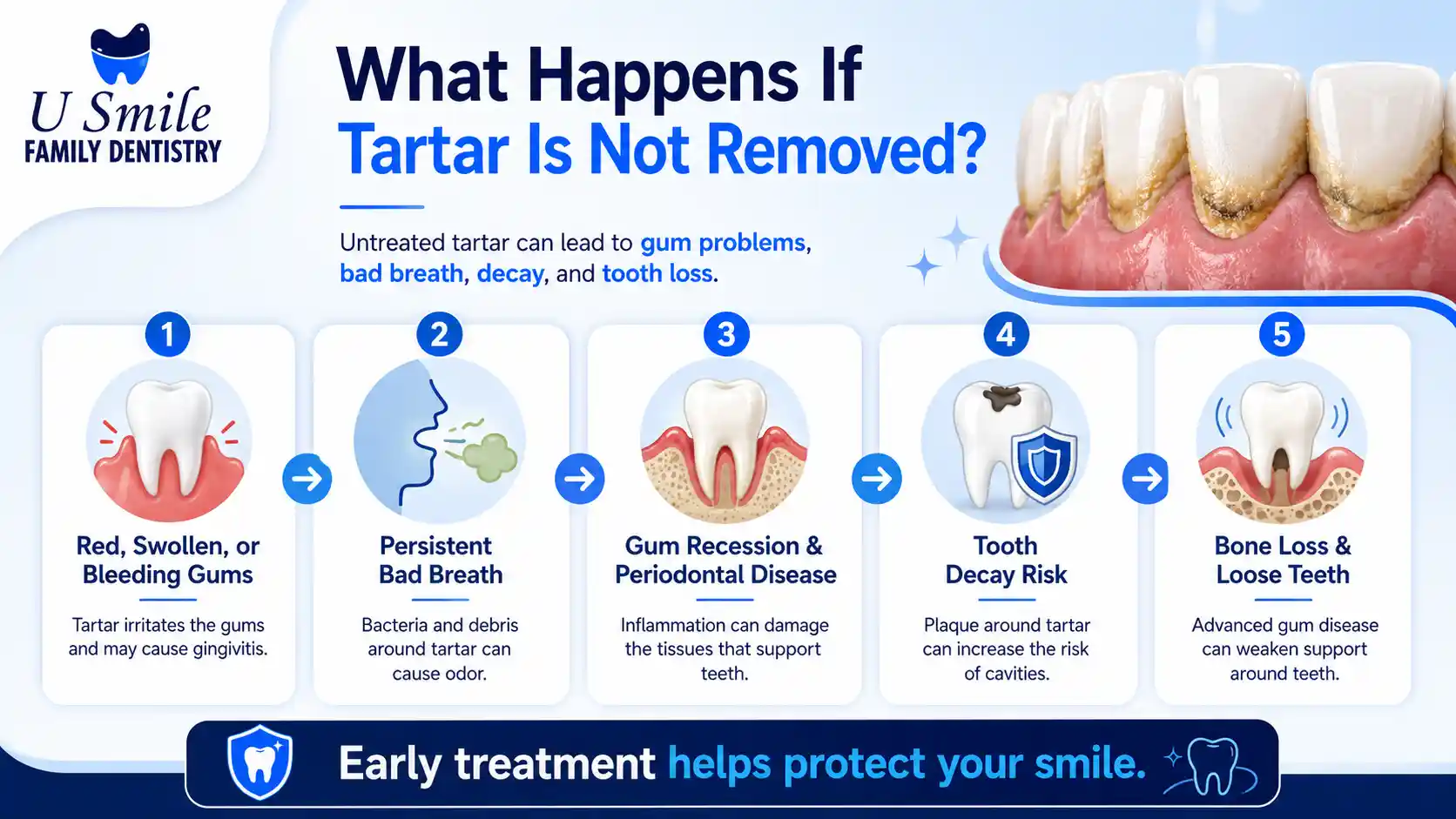 image showing what happens if tartar is not removed
