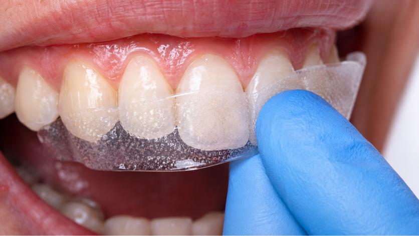 Dentist positioning a whitening strip on healthy natural teeth.
