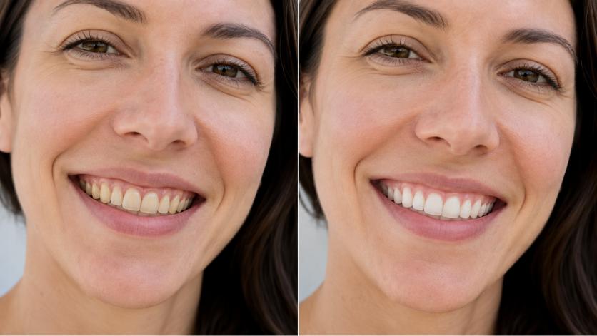 Comparison of teeth before and after whitening strip treatment.