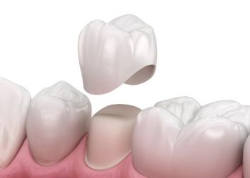 Preparated premolar tooth and dental crown placement. Medically accurate 3D illustration