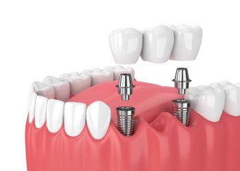 Dental-Implant