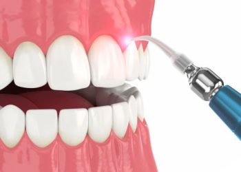 Laser Treatment