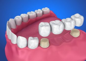 dental-bridge